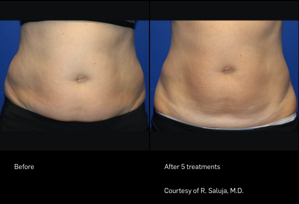 Body Sculpting | Before and After Photo